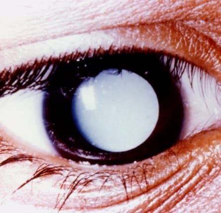 Cataract Surgery