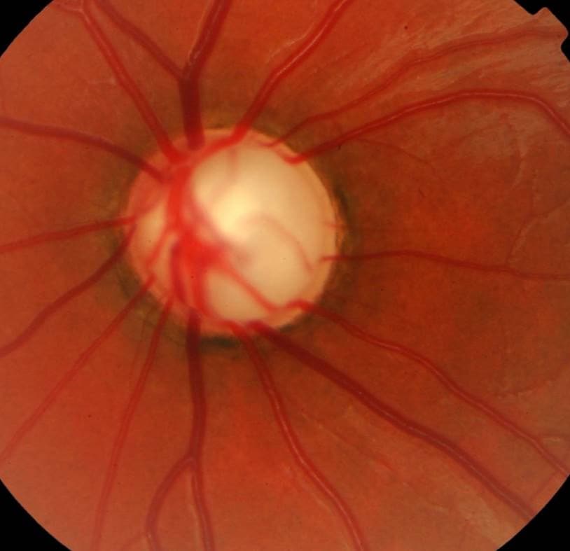 Glaucoma