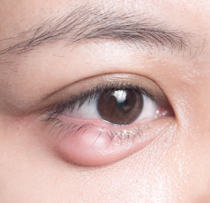 Oculoplasty